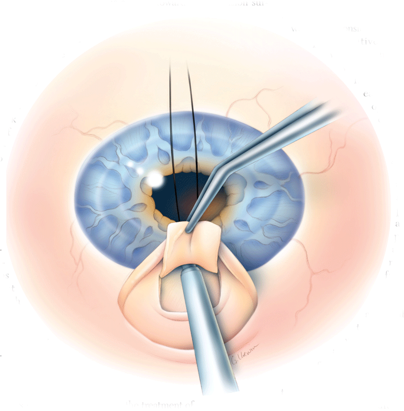 Trabeculectomy