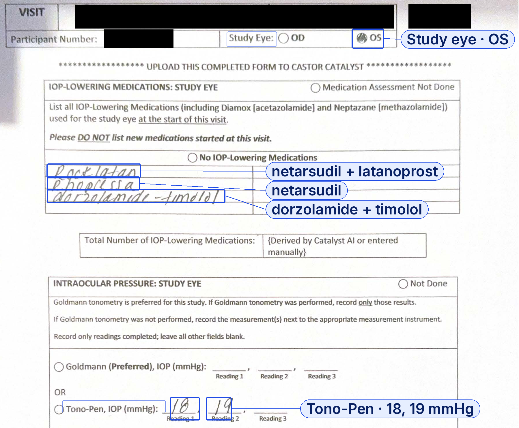 A handwritten IOP worksheet with the study name, participant number and visit redacted in black. Blue boxes mark the study eye, OS; three handwritten medications, Rocklatan, Rhopressa and dorzolamide-timolol, labelled with their active ingredients; and two Tono-Pen readings, 18 and 19 mmHg.